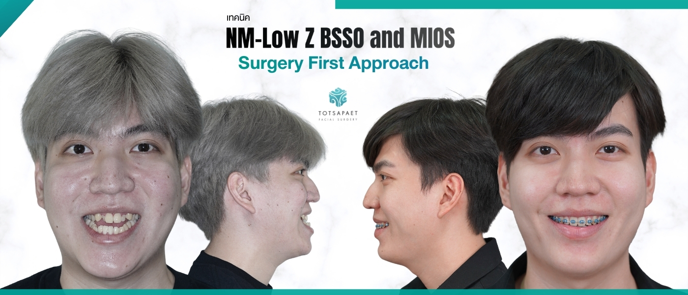 https://www.totsapaetsurgery.com/wp-content/uploads/2026/03/เวป1400x600-1.jpg